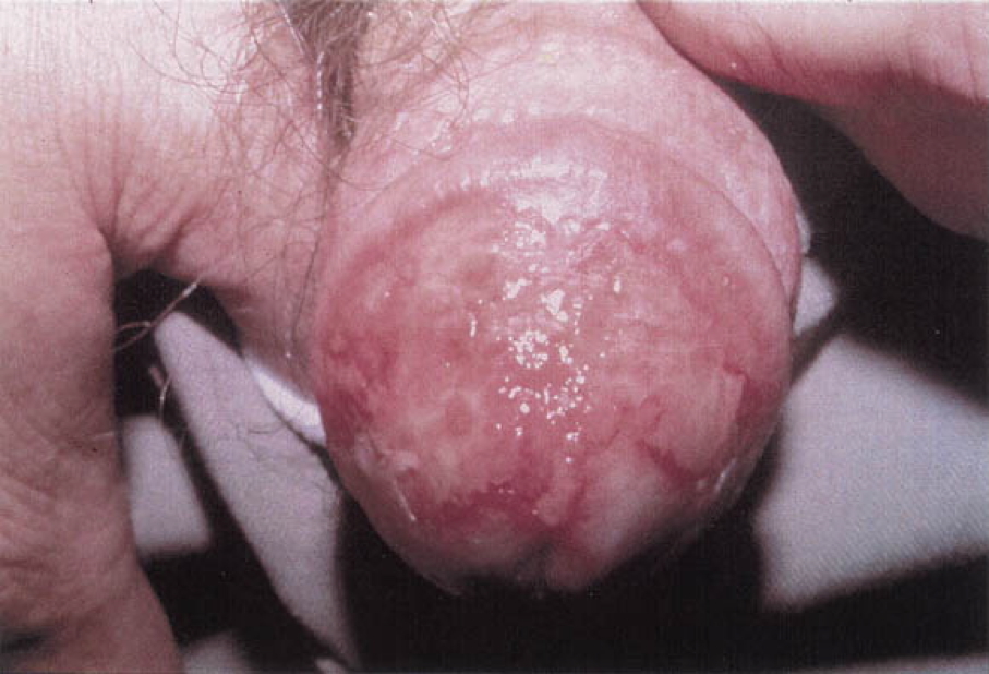 penile malignancies - CARCINOMA OF THE PENIS