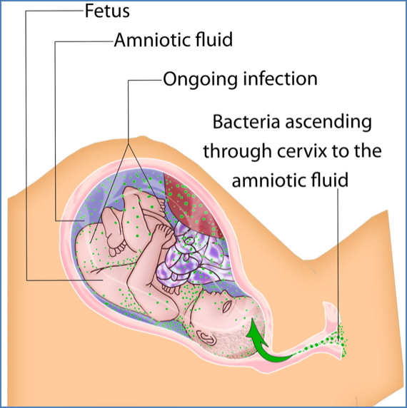 complications of labour: CHORIOAMNIONITIS