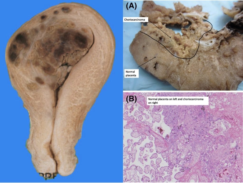obstetric tumours: Choriocarcinoma