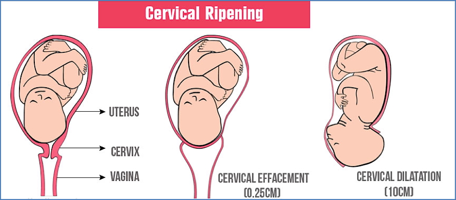 induction of labour: Cervical ‘Ripening’