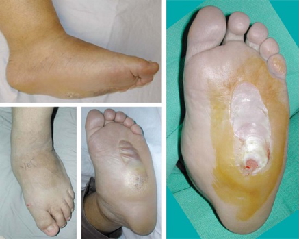 the endocrine examination: Charcot’s Joint