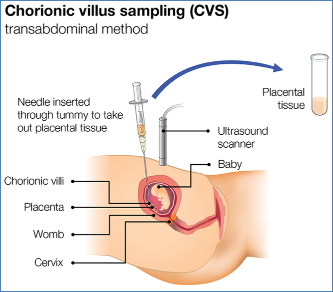 prenatal screening tests: Chorionic Villus Sampling
