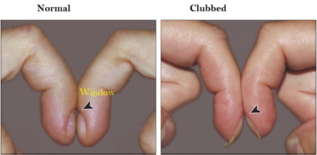 Clubbing