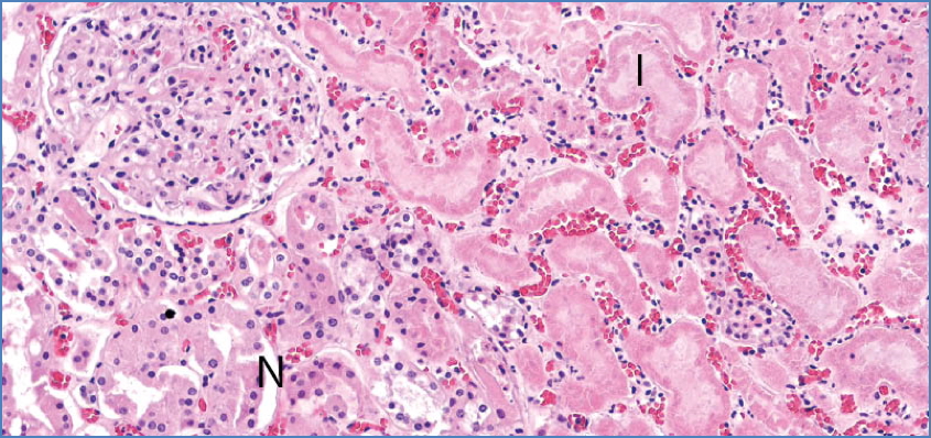 Coagulative Necrosis