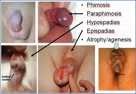 Congenital Penile Abnormalities