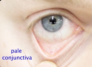 Conjunctival Pallor