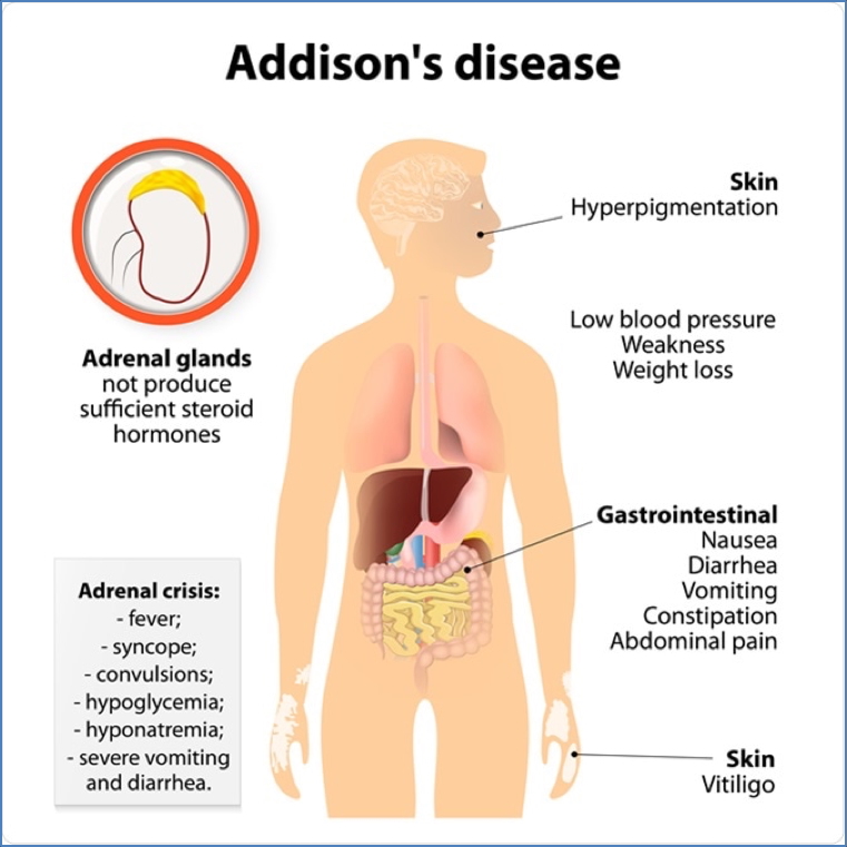 glucocorticoids & Addison’s Disease