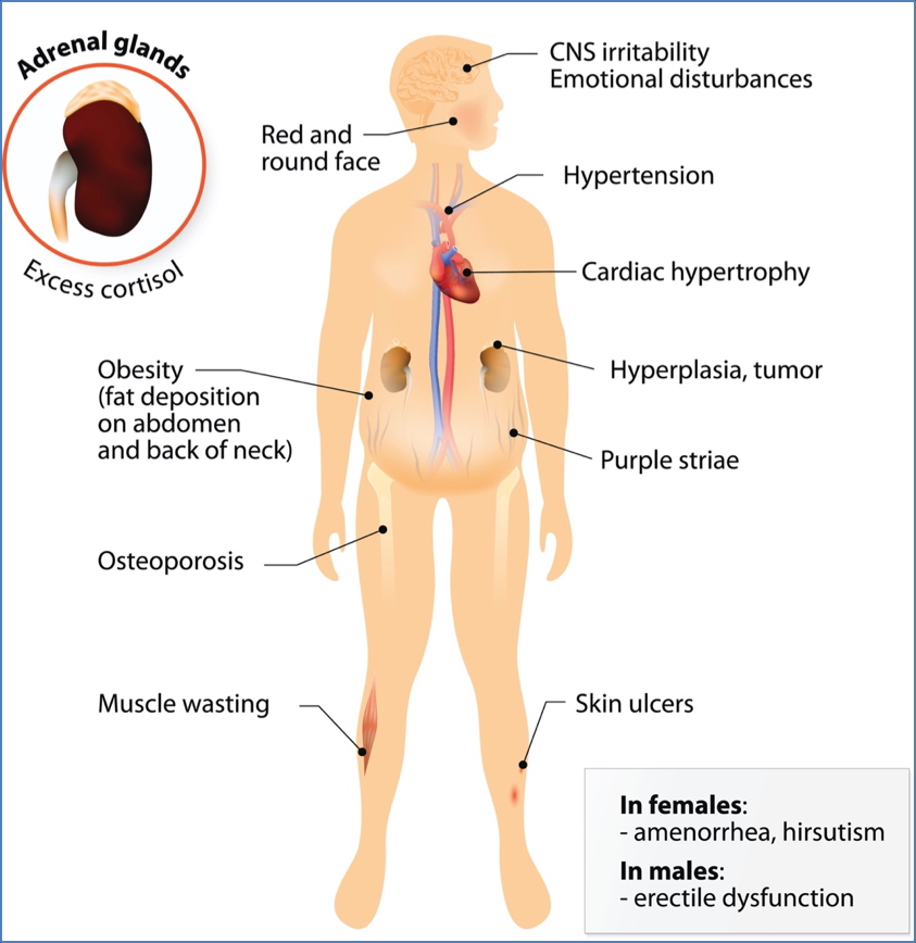 glucocorticoids & Cushing’s Syndrome