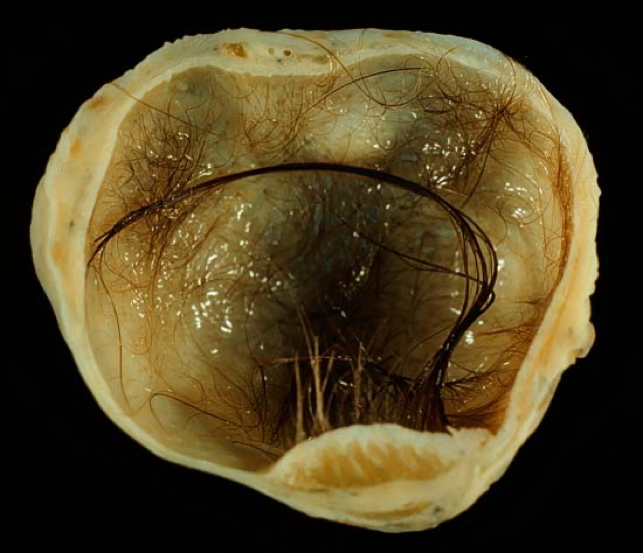 DERMOID CYSTS