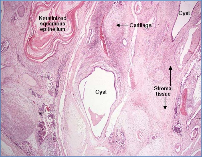 DERMOID CYSTS