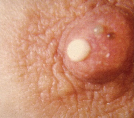 nipple obstructions: DUCT ECTASIA