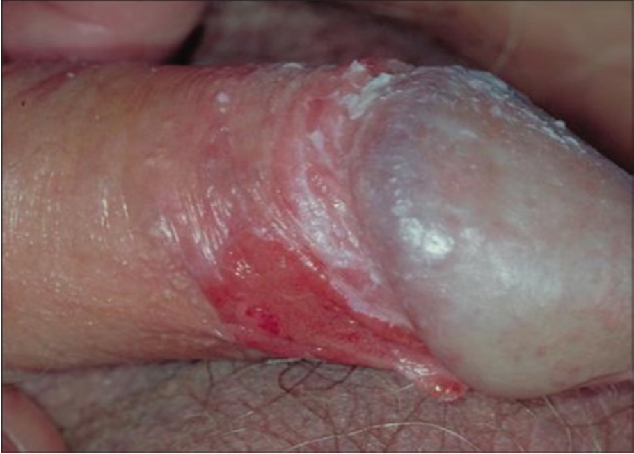 DYSPLASIAS OF THE PENIS