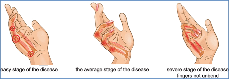 the gastrointestinal examination: Dupuytren’s Contracture