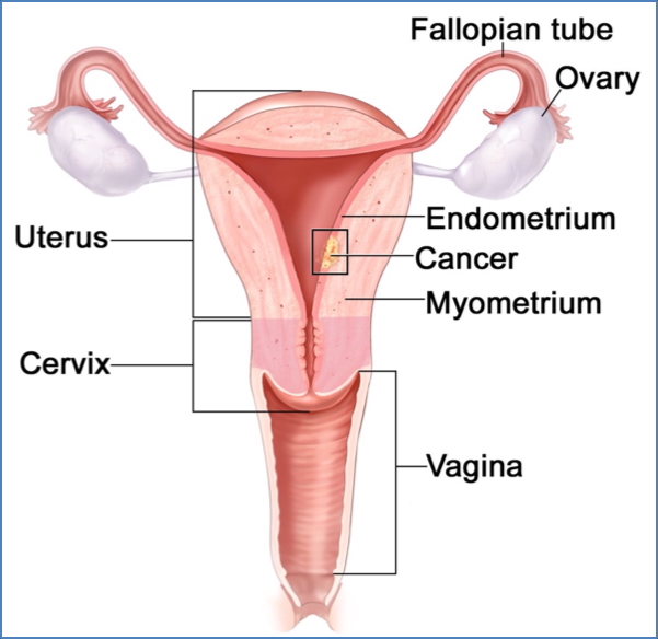 Uterine Cancers: ENDOMETRIAL ADENOCARCINOMA