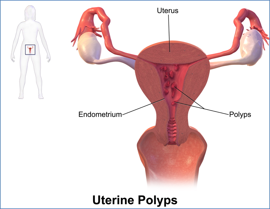 ENDOMETRIAL HYPERPLASIA