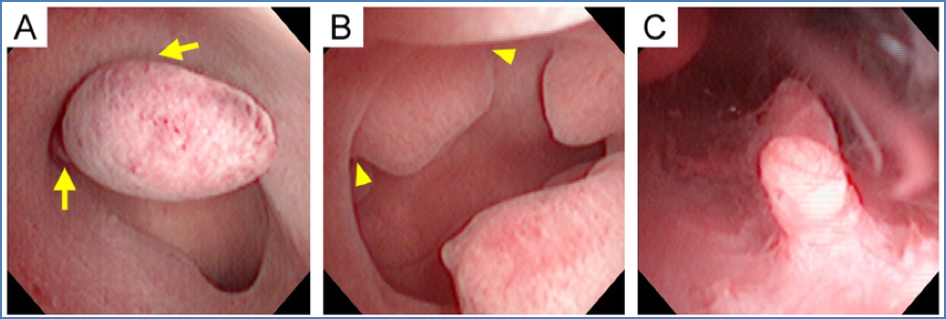 ENDOMETRIAL HYPERPLASIA