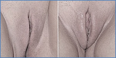 Female Sexual Arousal Disorder