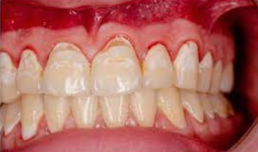 the haematological examination: Gum Hypertrophy