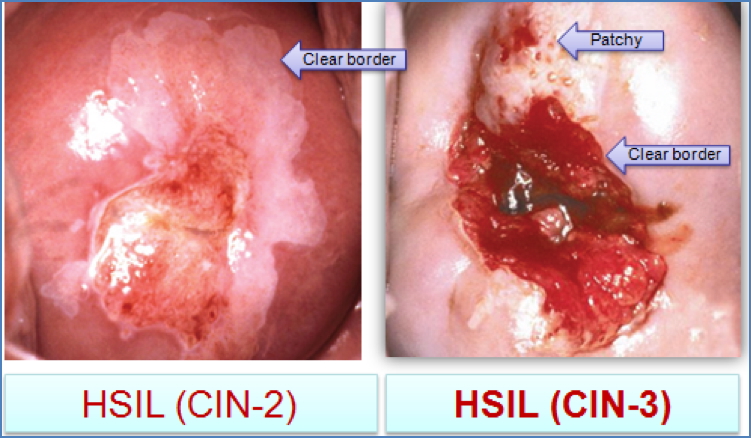 cervical cancers: HSIL- “High-grade Squamous Intraepithelial Lesion