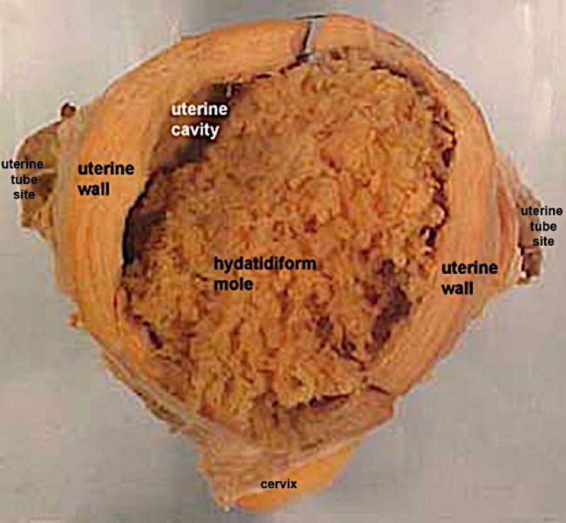 obstetric tumours: HYDATIDIFORM MOLES