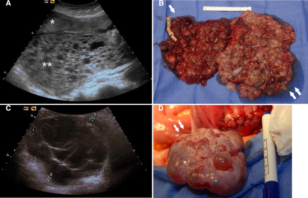 obstetric tumours: HYDATIDIFORM MOLES