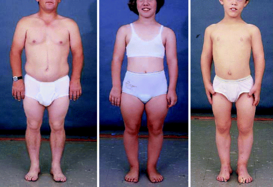 dwarfism genetics: HYPOCHONDROPLASIA