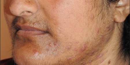 Hirsutism + Receding Hairline