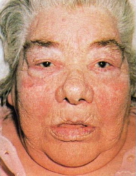 Hyperpigmented + Wasting (Addison’s