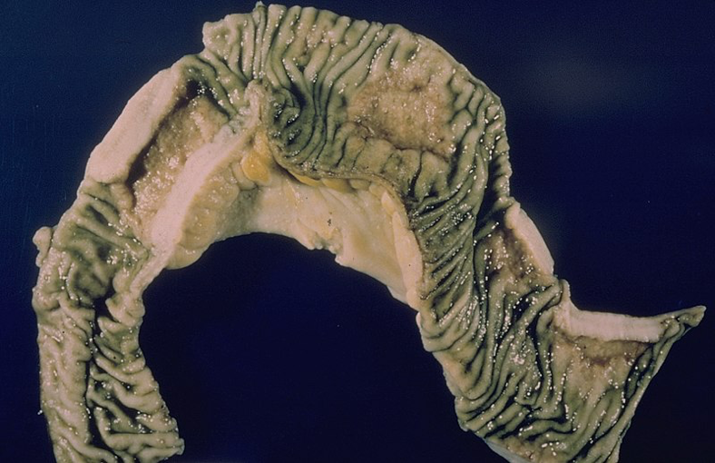 INTESTINAL TUBERCULOSIS