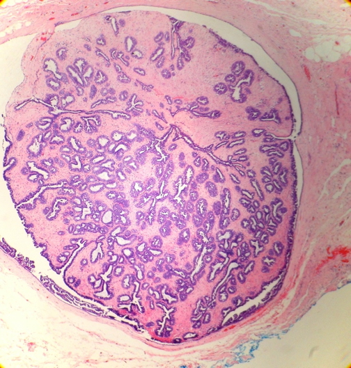 INTRADUCTAL PAPILLOMA
