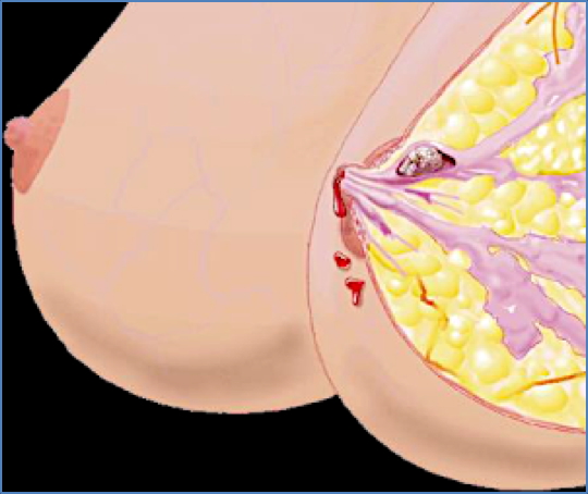 benign breast masses: INTRADUCTAL PAPILLOMA