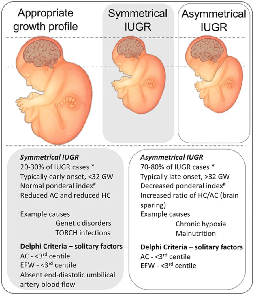 intrauterine growth anomalies: INTRAUTERINE GROWTH RESTRICTION