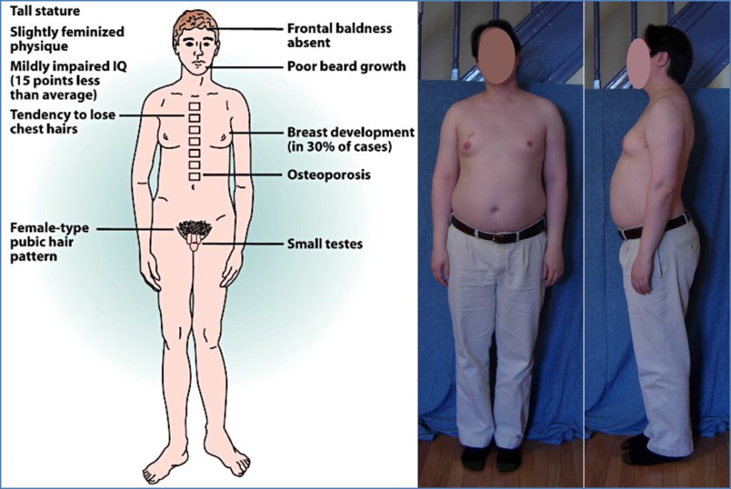 KLINEFELTER’S SYNDROME 47, XXY
