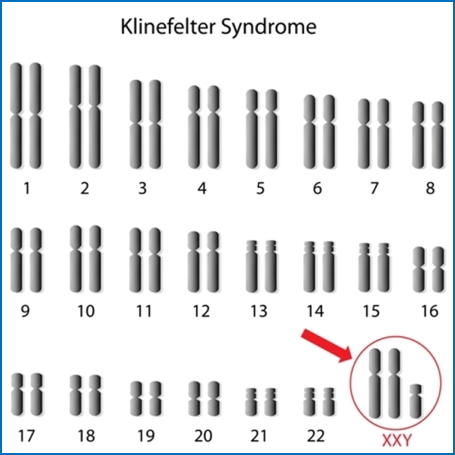 KLINEFELTER’S SYNDROME 47, XXY2