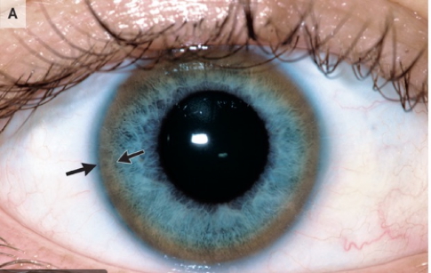 the gastrointestinal examination: Keyser Fleischer Rings