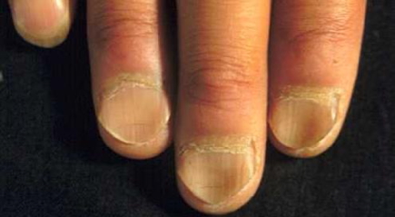 the haematological examination: Koilonychia