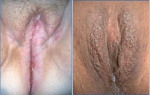 Lichen Simplex Chronicus