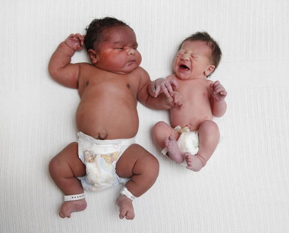 intrauterine growth anomalies: MACROSOMIA