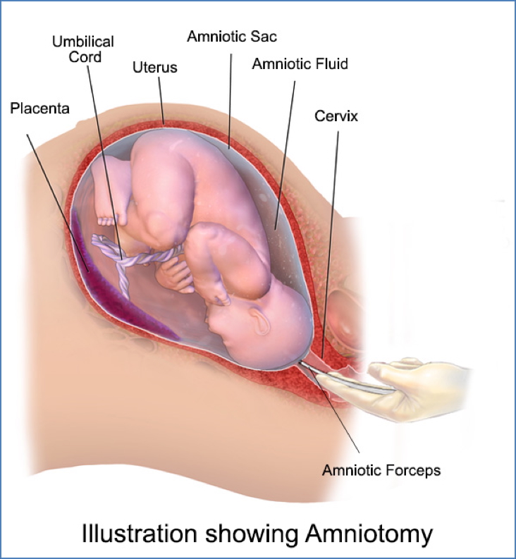 induction of labour: Amniotomy