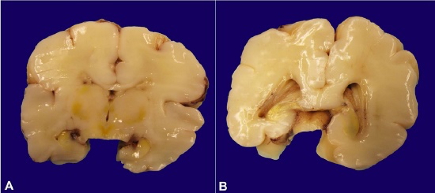NEONATAL JAUNDICE & KERNICTERUS