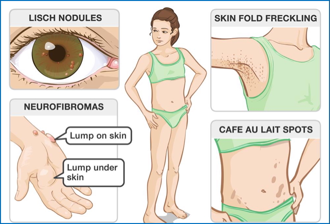 NEUROFIBROMATOSIS 1