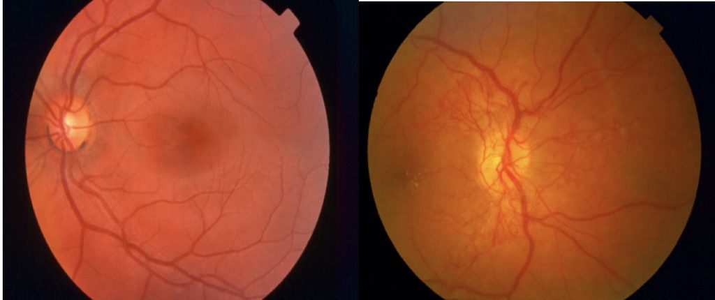 New Vessels (Proliferative Diabetic Retinopathy)