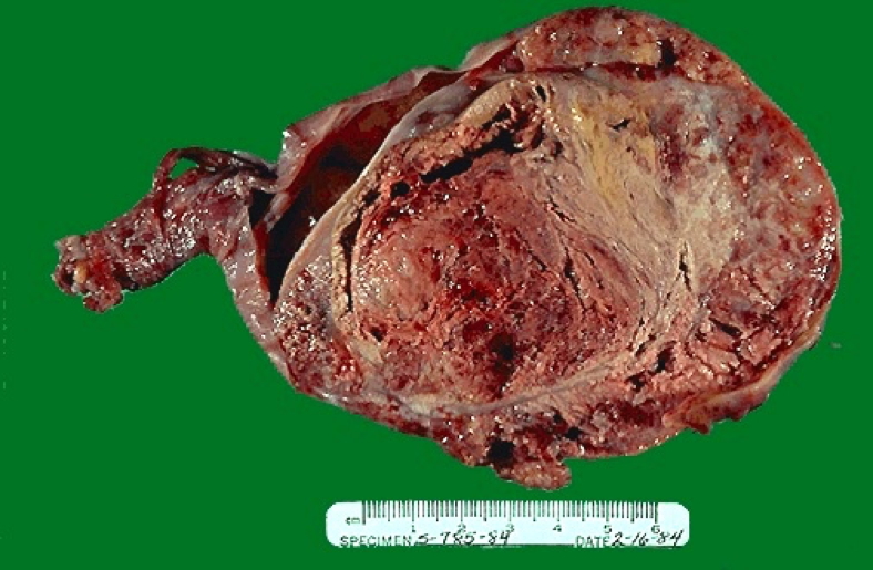 testicular tumours: TERATOCARCINOMA