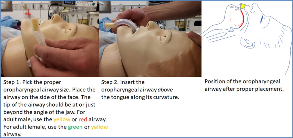treating respiratory emergencies: Oropharyngeal Airway