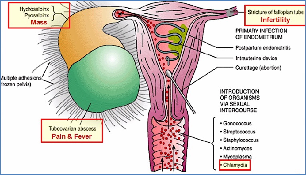 PELVIC INFLAMMATORY DISEASE