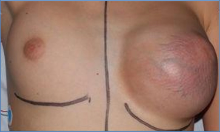 benign breast masses: PHYLLODES TUMOUR