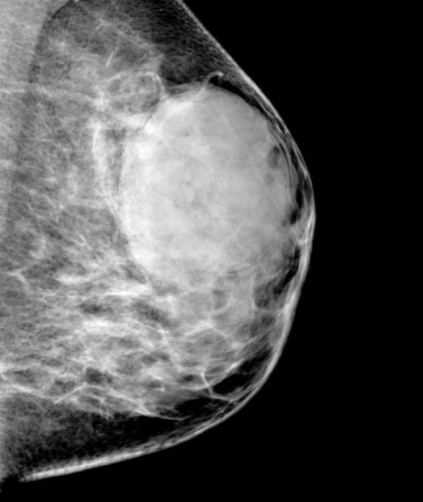 benign breast masses: PHYLLODES TUMOUR