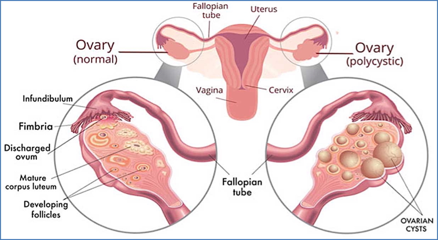 POLYCYSTIC OVARIAN SYNDROME 