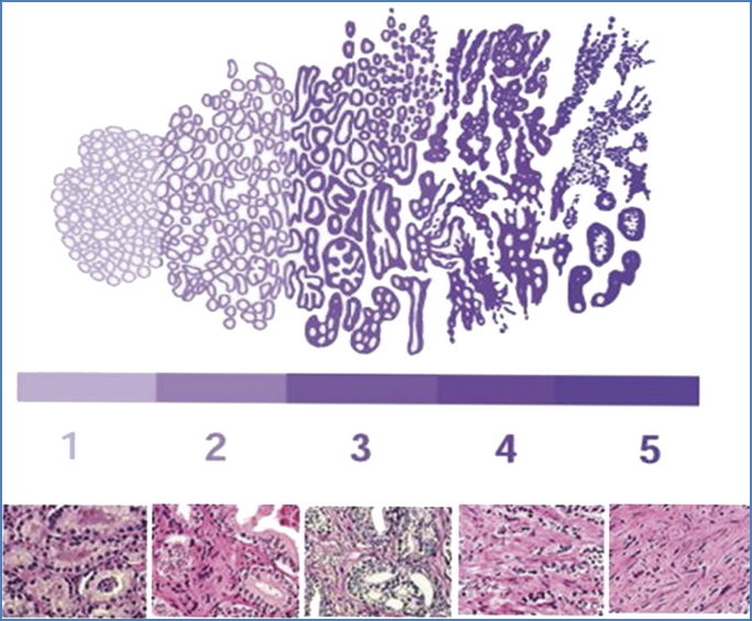 PROSTATE ADENOCARCINOMA
