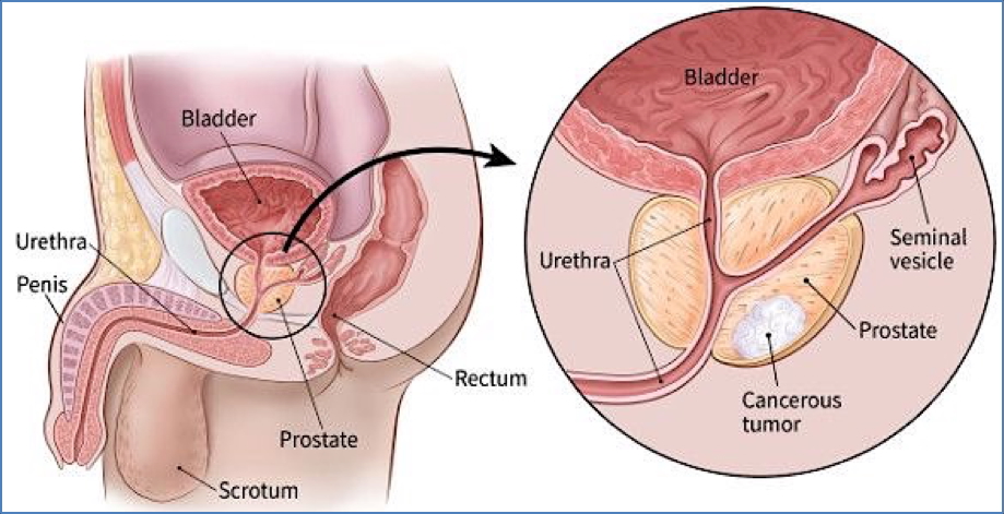 PROSTATE ADENOCARCINOMA